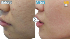 Singapore / Acne scar (Legato & PRP)