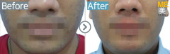 Singapore / Acne scar (MTS & PRP)