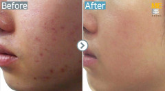 Singapore / Acne scar (Fraxel & PRP)