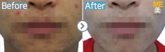 Singapore / Acne scar (Fraxel & PRP)