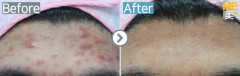 Singapore / Acne scar (MTS & PRP)