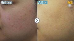 Singapore / Acne scar (Legato & PRP)