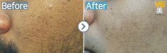 Singapore / Acne scar (Fraxel & PRP)