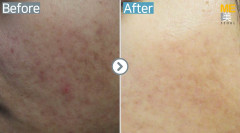 Singapore / Acne scar (Fraxel & PRP)