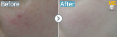 Singapore / Acne scar (MTS & PRP)