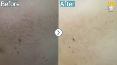 Singapore / Acne scar (MTS & PRP)