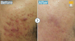 Singapore / Acne scar (MTS & PRP)