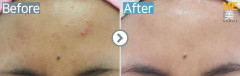 Singapore / Acne scar (MTS & PRP)