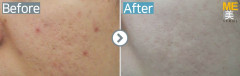Singapore / Acne scar (MTS & PRP)