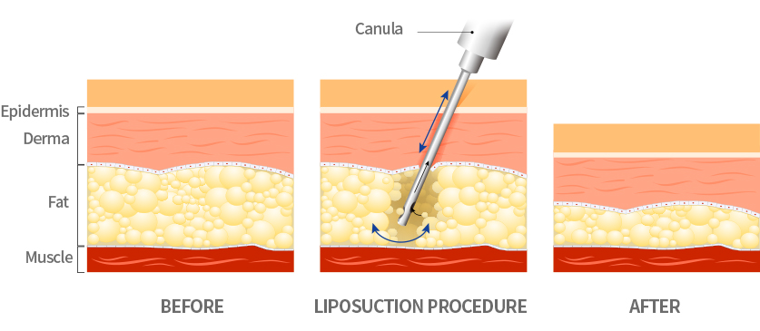 Liposuction