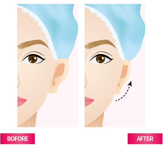 Otoplasty