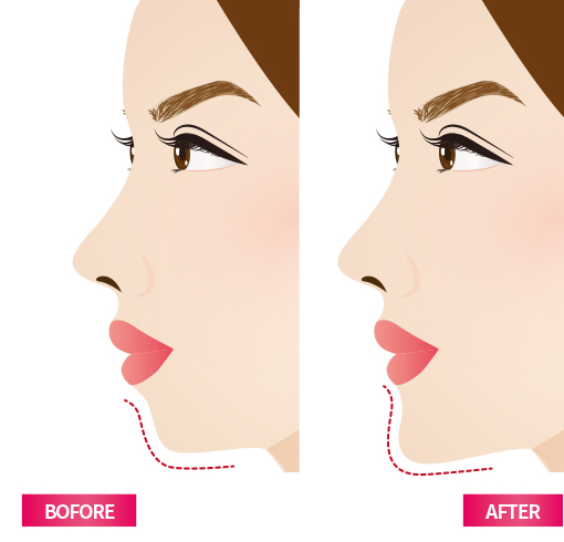Chin implant