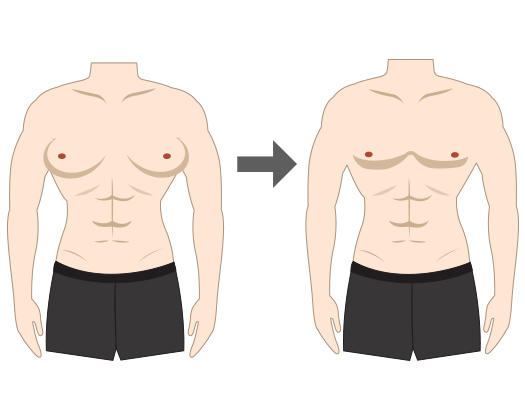 Gynecomastia