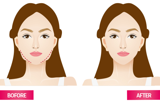 Face & Neck lifting