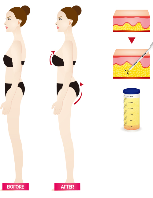 Breast Fat graft enlargement