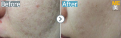 Singapore / Acne scar (Legato & PRP)