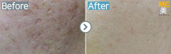 Singapore / Acne scar (Legato)