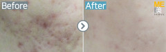 Singapore / Acne scar (Legato)