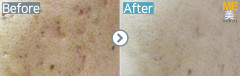 Singapore / Acne scar (Legato)