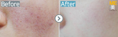 Singapore / Acne scar (Legato)
