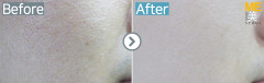 Singapore / Acne scar (Fraxel xena)