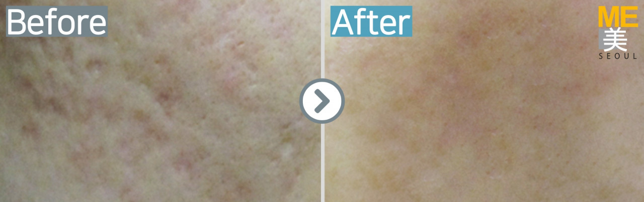 Acne scar ME CLINIC SEOUL