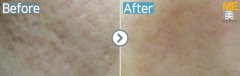 Singapore / Acne scar (Fraxel xena)