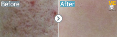Singapore / Acne scar (Fraxel xena)