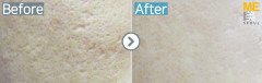 Singapore / Acne scar (Fraxel xena)