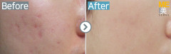 Singapore / Acne scar (Fraxel xena)