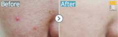 Singapore / Acne scar (Fraxel xena)