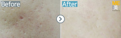 Singapore / Acne scar (Fraxel xena)