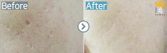 Singapore / Acne scar (Fraxel xena)