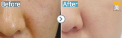 Singapore / Acne scar (Fraxel xena)