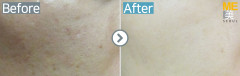 Singapore / Acne scar (Fraxel xena)