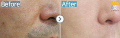 Singapore / Acne scar (Fraxel xena)