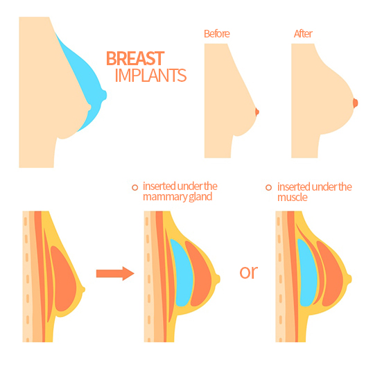 BREAST IMPLANTS