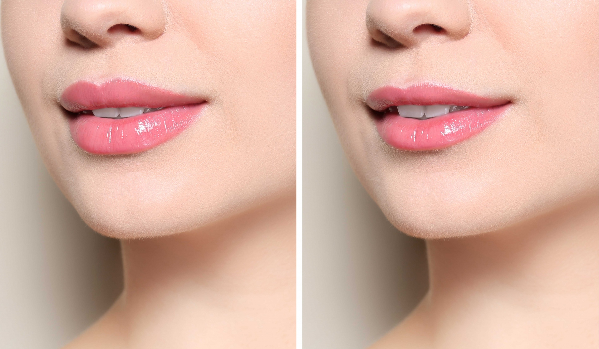 lip size reduction