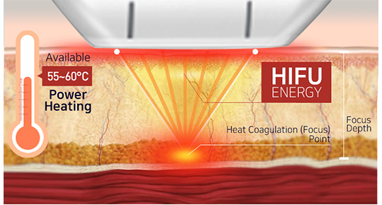 HIFU treatment theory